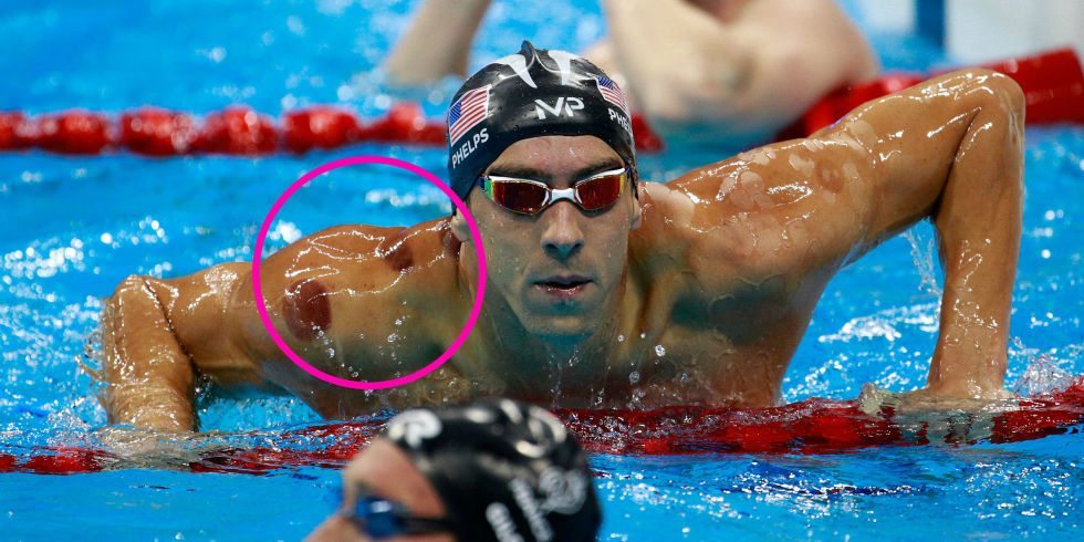Michael Phelps Cupping Islamic Hijama Olympic Athletes Red Circles